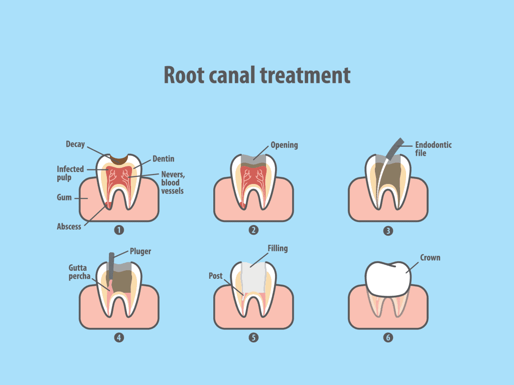 root canal treatment