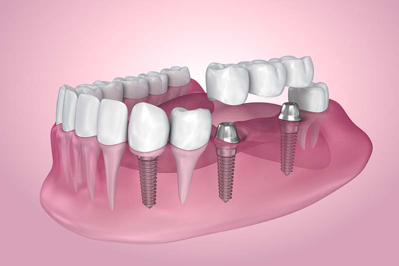 dental-implant-bridge