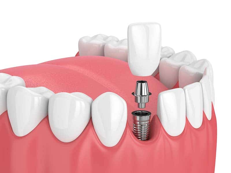 dental-implants