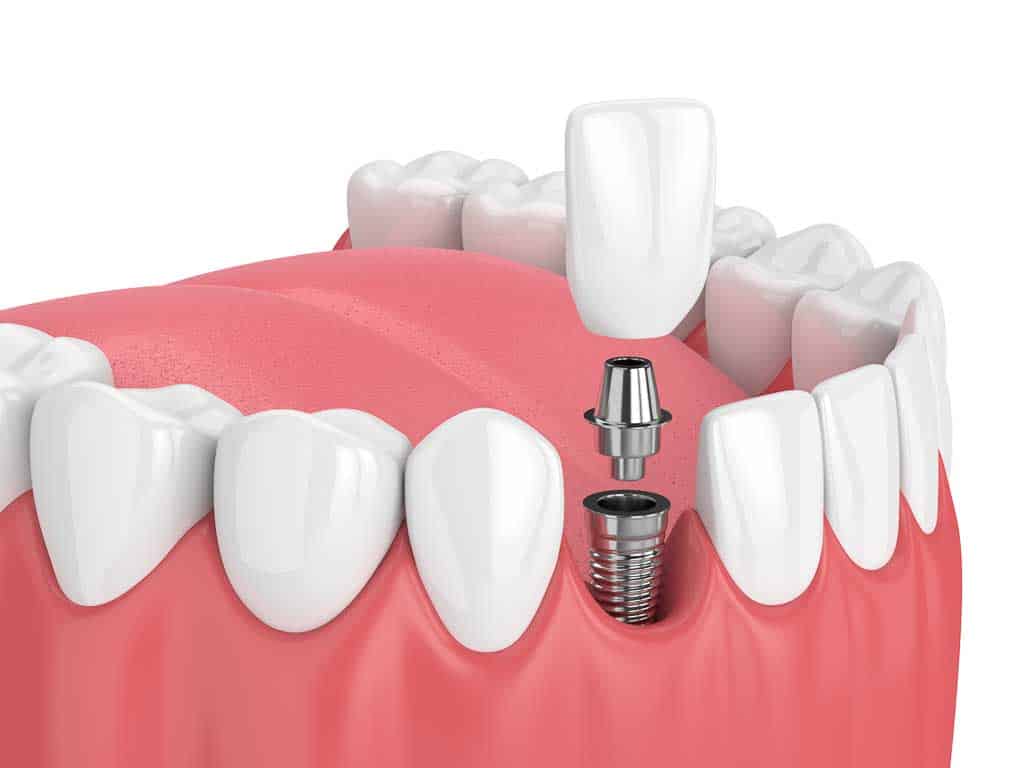 dental implants