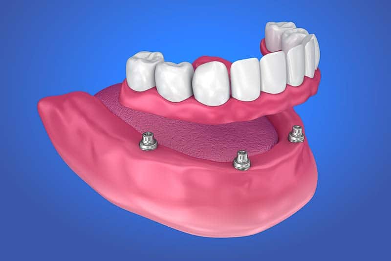 implant-denture