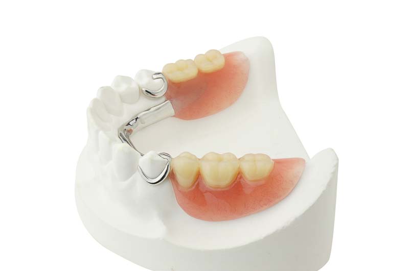 removable-partial-dentures