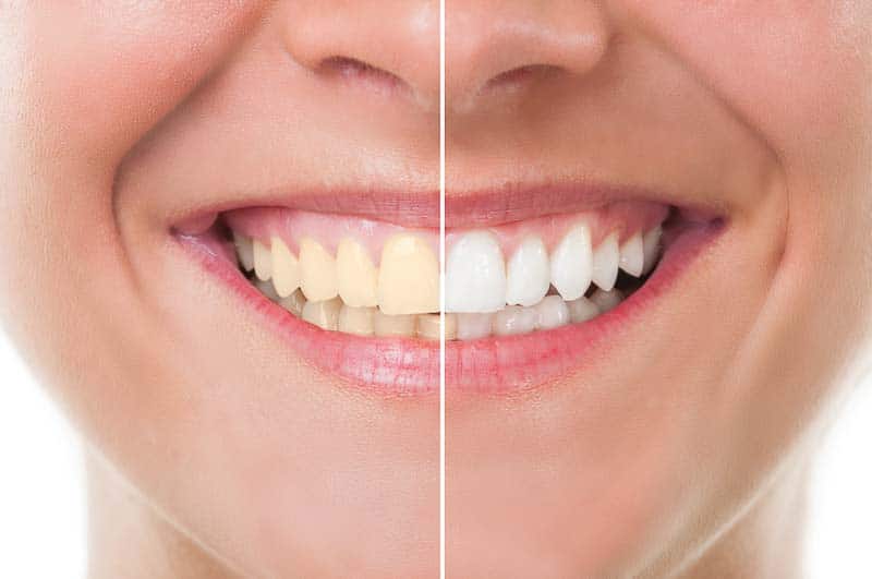 tooth-whitening