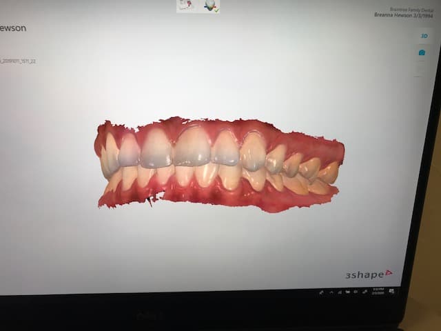 digital tooth scans
